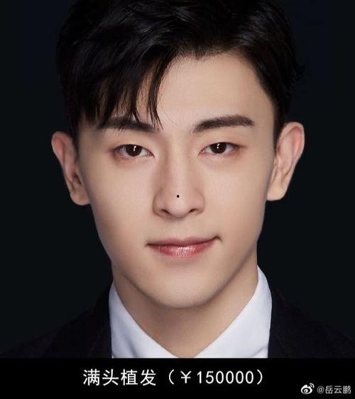 邓伦整容前后照片